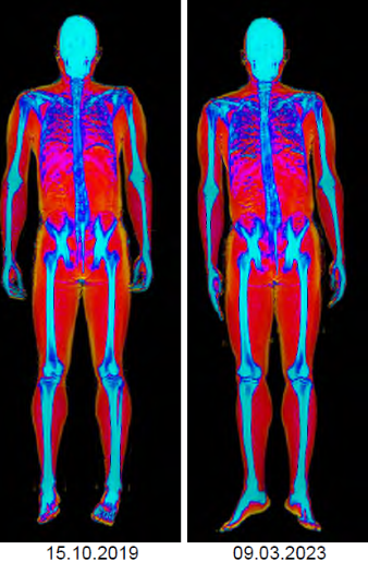 3D Body Scan Perth | Perth Dexa Scan