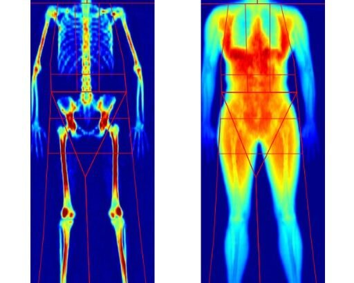 What Does a DEXA Scan Show