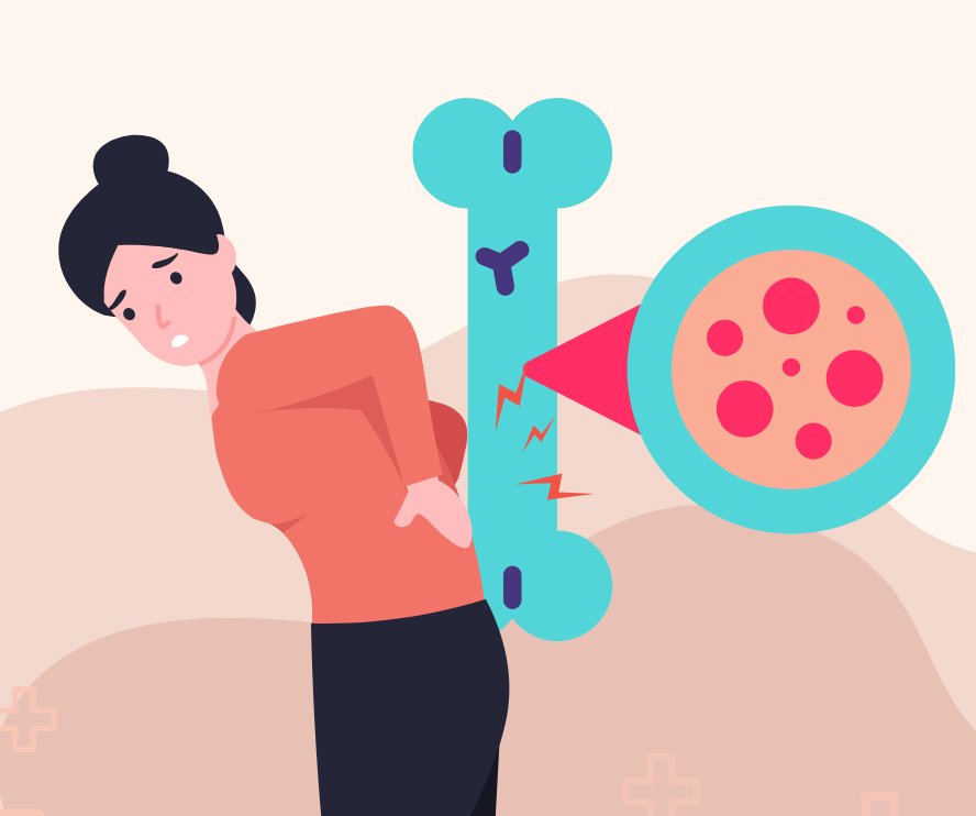 Osteoporosis