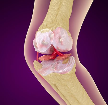 osteoporosis