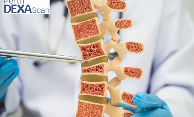 Osteoporosis