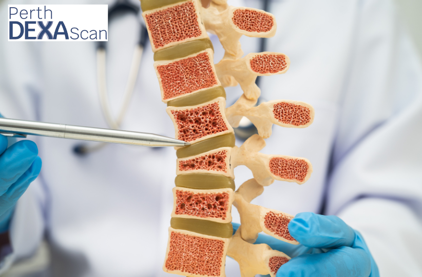 Osteoporosis